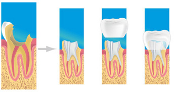 prothese dentaire paris 16