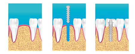 implantologie dentaire Dr carel paris 16